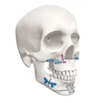 Arcos Mini Sistema 2.0mm