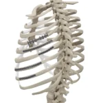 FixRibs